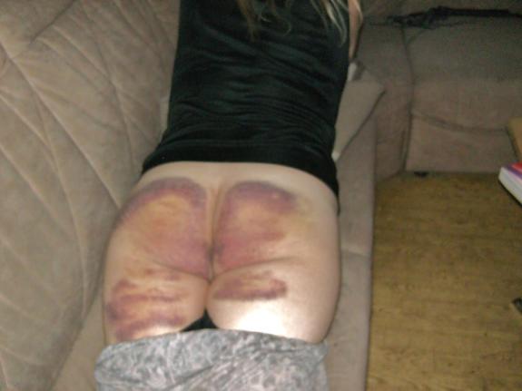 Picture Spanking Bruises Blog - The Spanking Blog - Spanking News, Spanking Reviews and ...